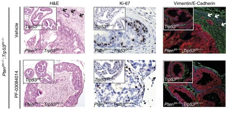 Prostate tumour sections from Pten and Trp53 null mice stained with haematoxylin and eosin, Ki-67, and vimentin and E-cadherin immunofluorescence, comparing vehicle with a Notch inhibitor.